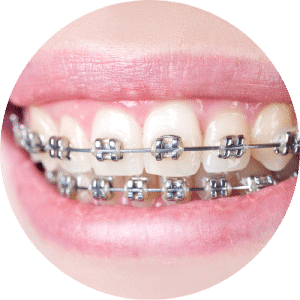 Metal Braces - Prosper Trail Orthodontics